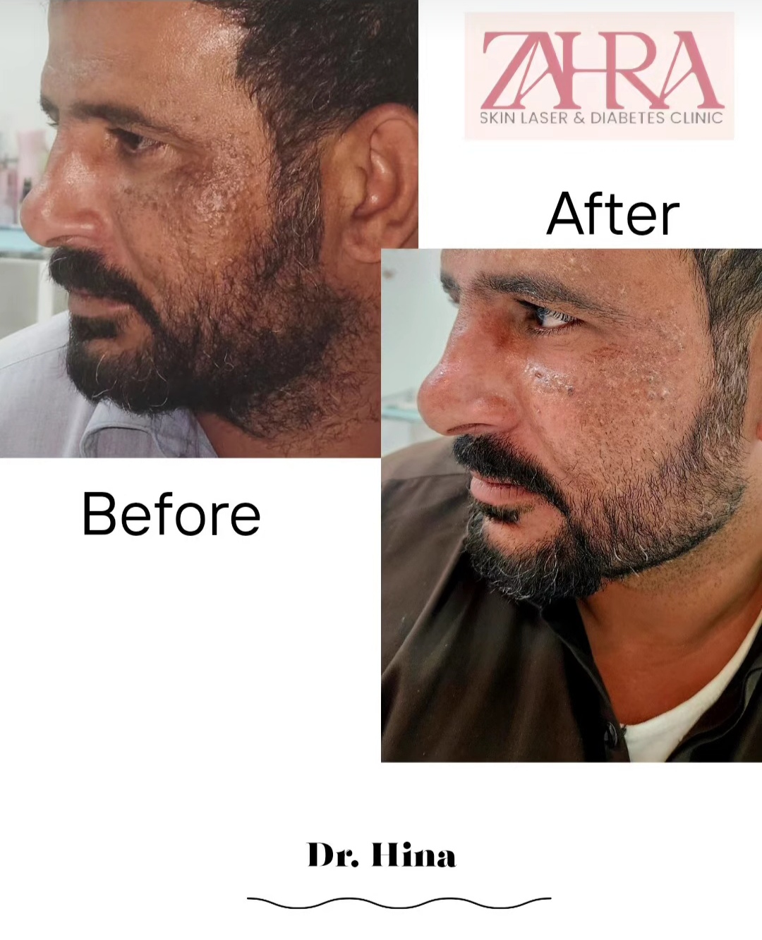 Acne scar before and after treatment result