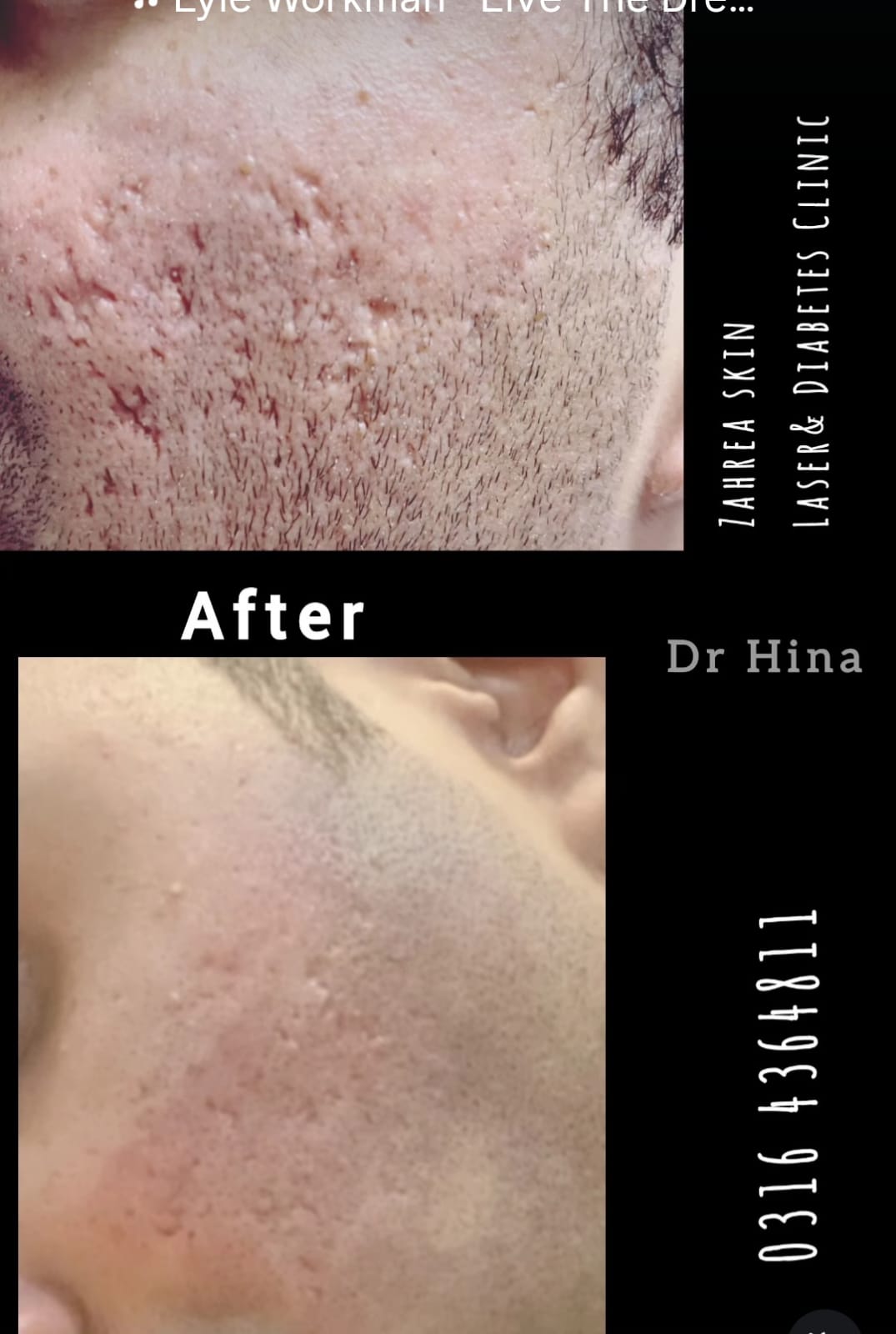 Before and after skin treatment result 2