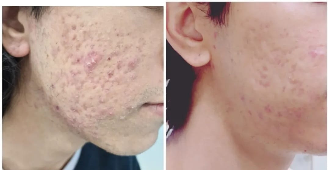 Before and after skin treatment result 3