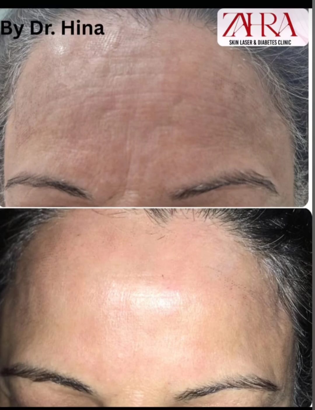 Before and after skin treatment result 4