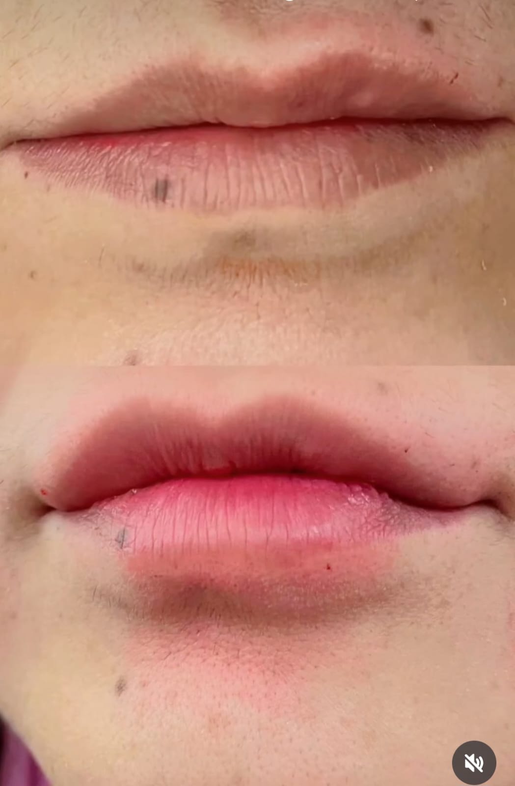 Before and after skin treatment result 5