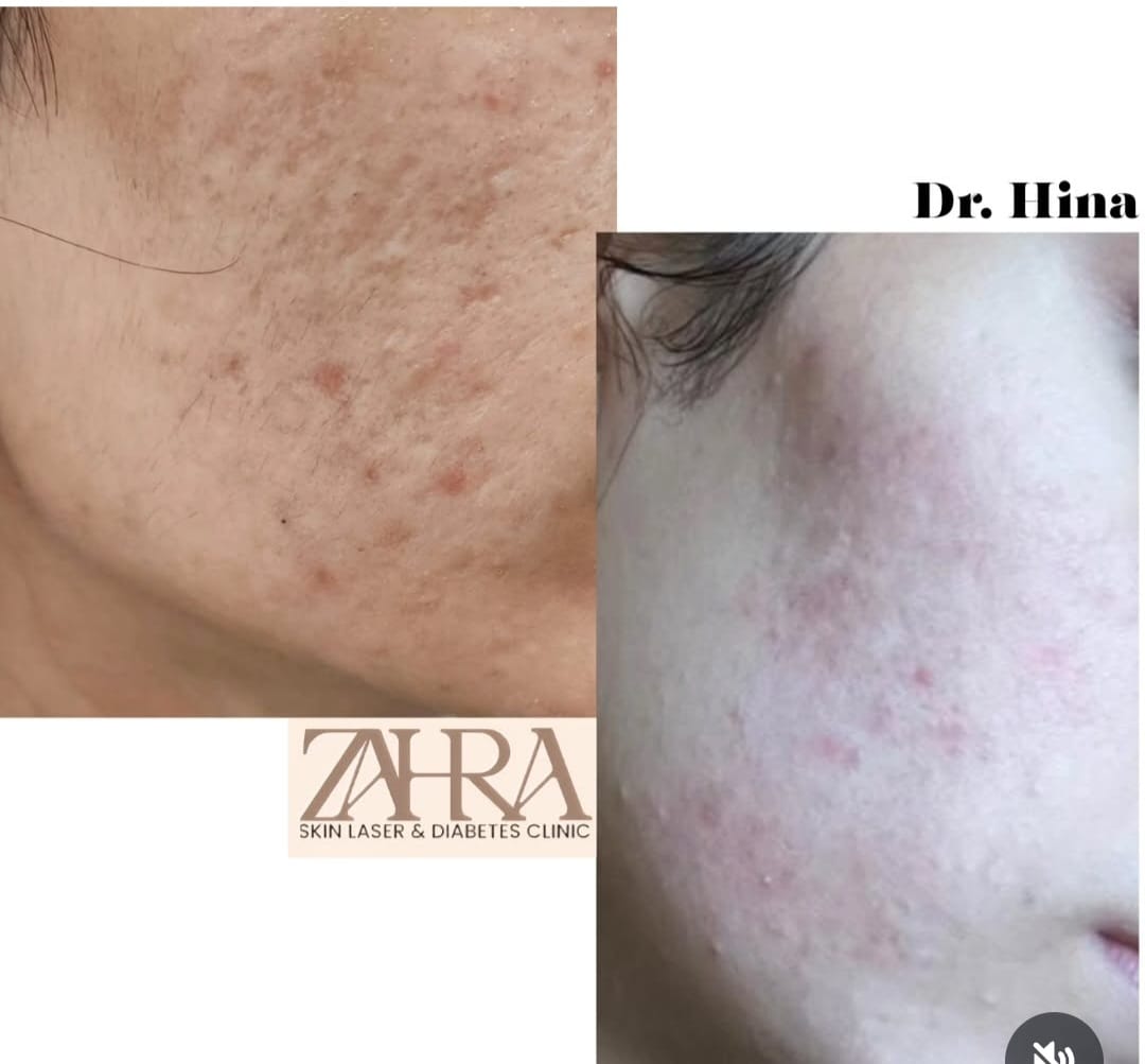 Before and after skin treatment result 6
