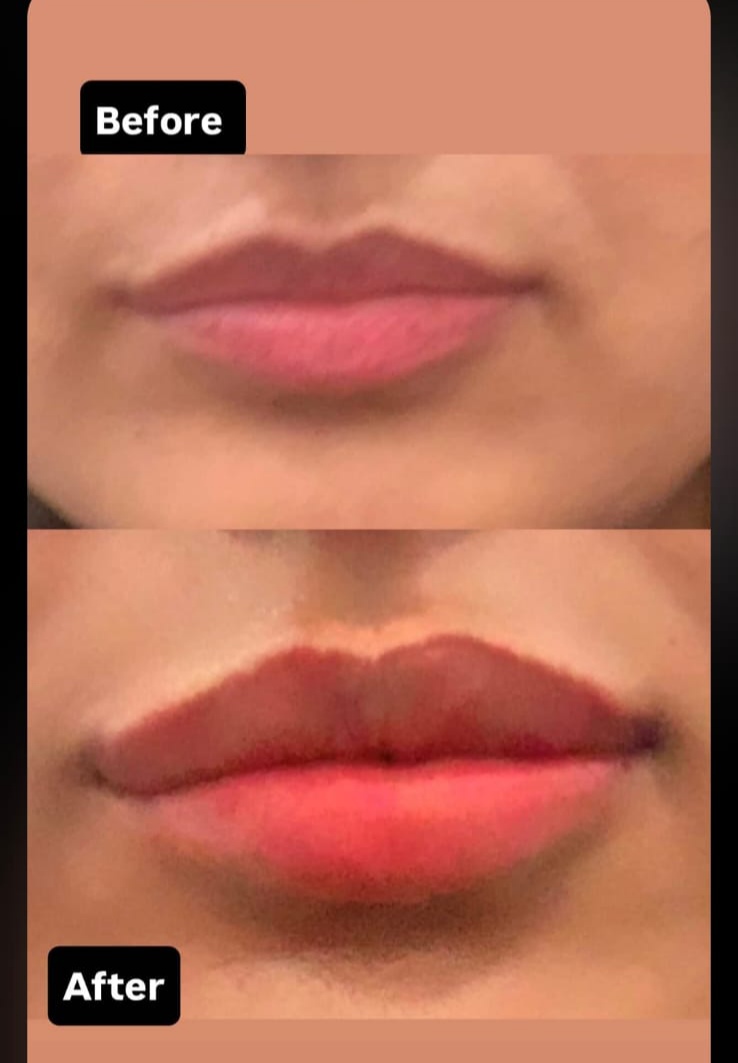 Lip enhancement before and after treatment result