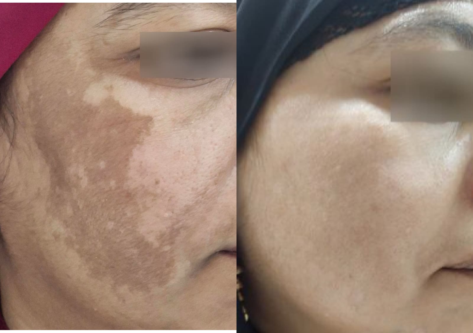 Melasma before and after treatment result