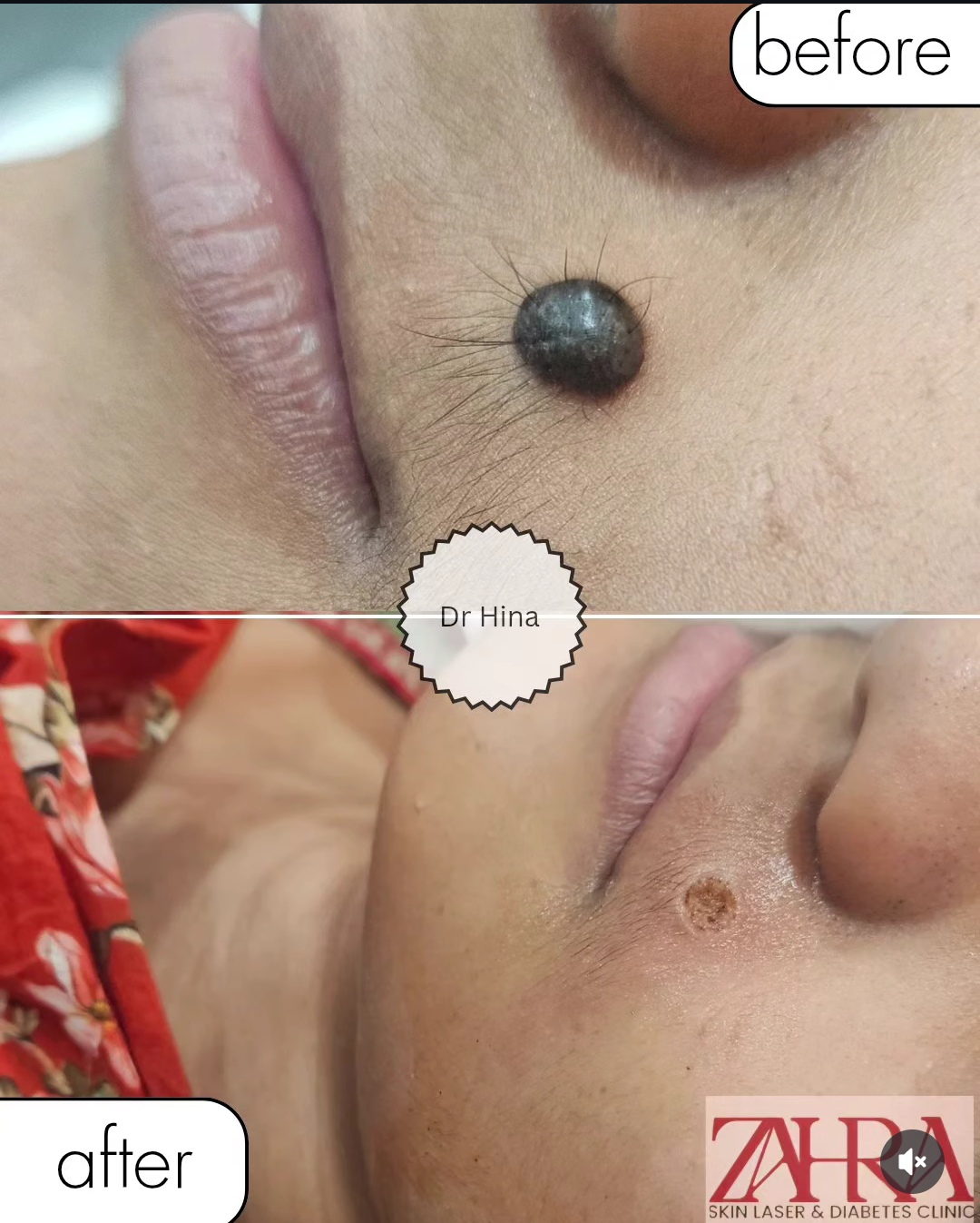 Mole removal before and after treatment result