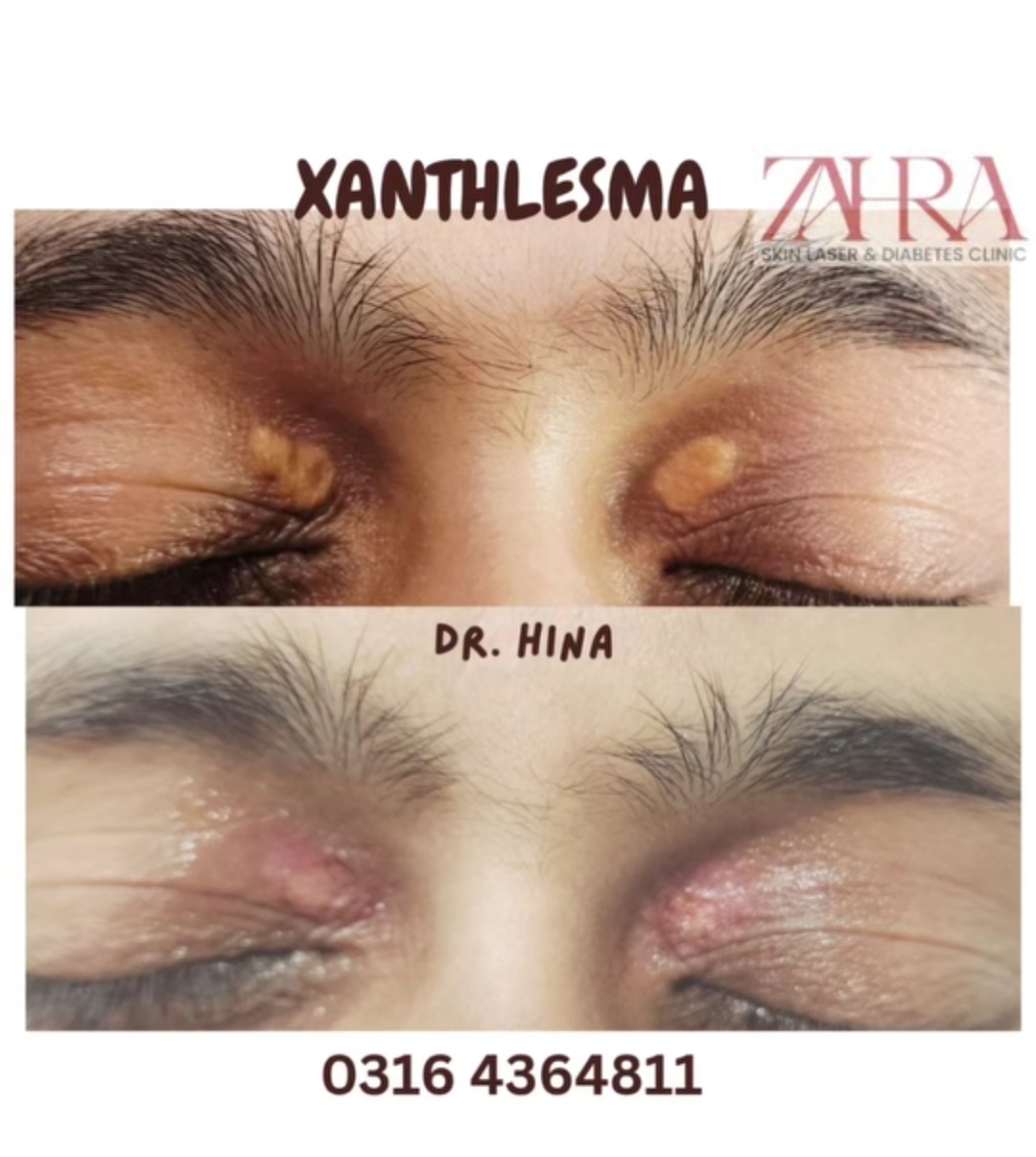 Xanthelasma before and after treatment result